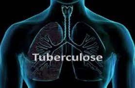 Tuberculose : Plus de 25.286 malades, toutes formes confondues, en 2022 au Cameroun